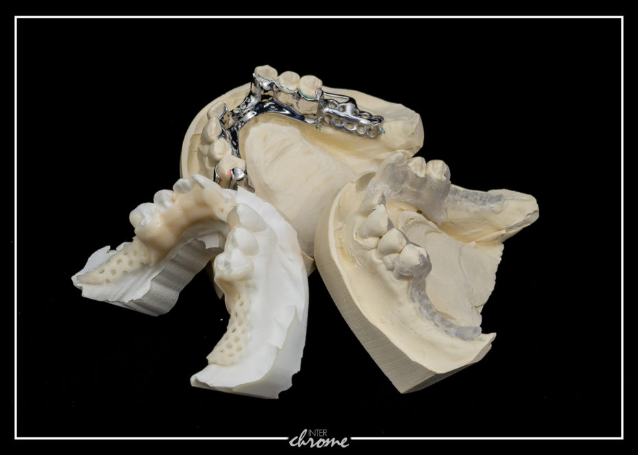 Cast partial and Flex Partial