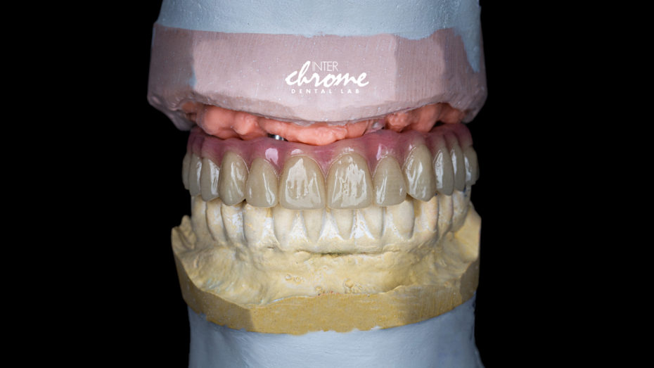 Finished screw retained acrylic hybrid