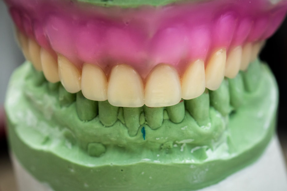 Immediate Denture - Full Setup