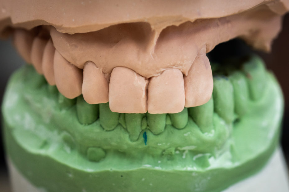 Immediate Denture - Before